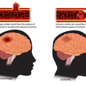 different types of stroke explained