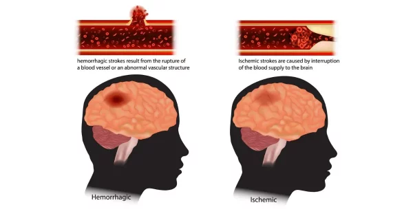 different types of stroke explained