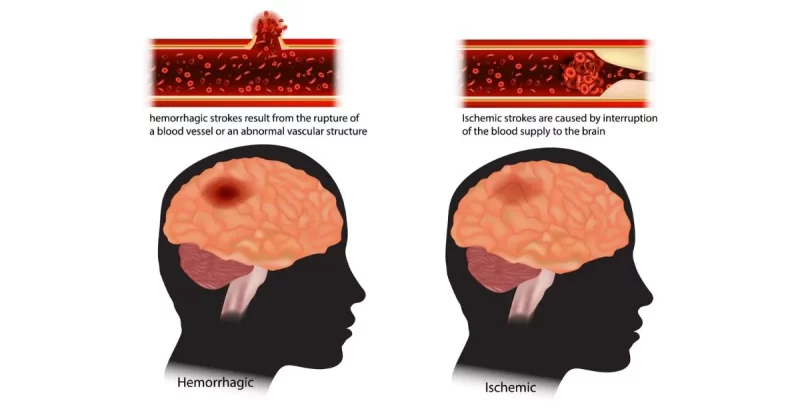 different types of stroke explained