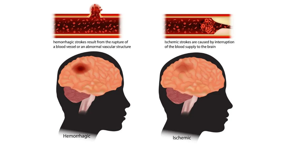 different types of stroke explained