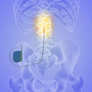 example of transcutaneous spinal cord stimulation