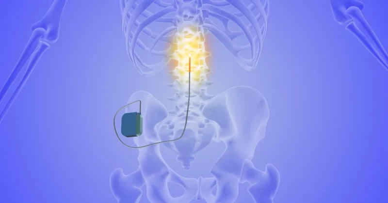 example of transcutaneous spinal cord stimulation