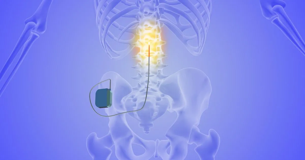example of transcutaneous spinal cord stimulation