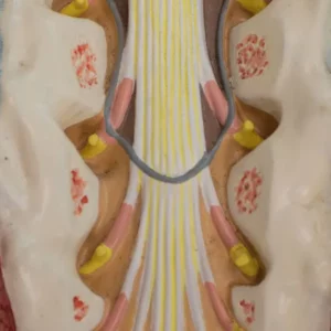 illustration of cauda equina syndrome