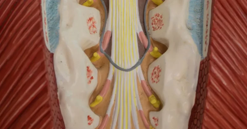 illustration of cauda equina syndrome