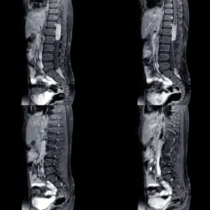 mri of conus medullaris syndrome